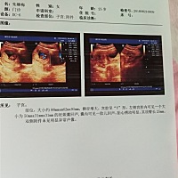 各位宝妈来看B超单猜男女宝宝，这是两个月的B超