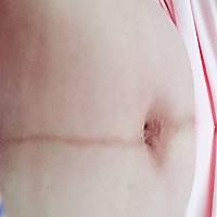 生完宝宝第10天拍的，有宝妈同款肚子妈，黑色线有办法去掉吗，肚子上还长了好多毛毛，怎么去？