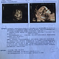 胎盘前置怎么办，害怕的，第二胎，想顺产，不知道会不会上去