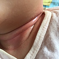 宝宝脖子是淹的吗？涂了桃子水和婴宝都没用，现在每天用金银花洗脖子，还是这么红，有没有什么办法快好啊