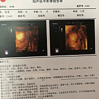 看Ｂ超单都说看的出来男女。都说是女孩，不知道准不