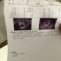 宝宝早产一个月，今天10天，做了心脏彩超，显示房间隔缺损，继发孔，0.21cm。有没有人懂这个？严重吗？...