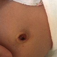 宝宝出生第9天肚脐掉了，肚脐里面有血结痂，需不需要处理，把血痂擦出来，还是等待血痂自己干掉掉下来，...