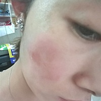 皮肤过敏了，也不能涂药，不能吃药，真心难看和难受啊，身上痒痒的可以喷花露水吗