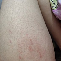 怀孕三个月  请问下一条大腿处有这些是什么？ 妊娠纹？