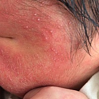 宝宝脸上起这个怎么办，炉甘石可以用吗