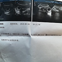 刚检查的，是不是看不出来妊娠囊形状，听说是要3个数据看男女
