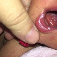 唉...真是烦死了！奶水不够吃就够着急得了！宝宝这两天嘴里又起了好多小白泡，越来越多，有经验的宝妈帮...