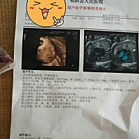 脐带绕颈一周，有没有什么事宝妈们你们有遇到过吗。