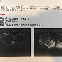 末次月经7月11，今天去照了阴超，宫内。就是上次抽血说我有甲减，医生开了一个月药，要吃完了去复查。