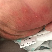 宝宝19天了，这两天突然脸上发了好多小红点。是怎么回事？是热了还是什么？要不要擦东西的？