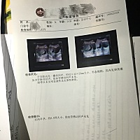 今天11周上厕所纸上轻微粉色血 内裤上没有 然后去挂急诊b超 说测不到胎心 小孩偏小 验血报告明天拿 😭...