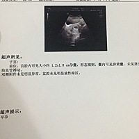 能看出来男女吗？怀孕41天B超