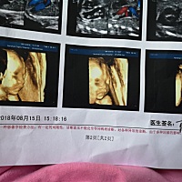 前天晚上睡觉被儿子踢了一下肚子，当时没有太在意，早上起床上厕所白带有红血丝，急急忙忙跑医院挂急诊...