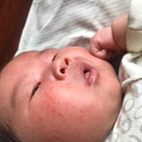 脸上有痘痘还有白色的咋回事