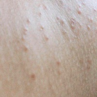 孕33周，最近一个月身上开始长东西现在越来越严重了。去医院看了也没有用。有孕妈长过这个东西的嘛，到...