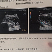 怀月两个多月 吐的不行 一开始的时候吐酸水 苦水 血水  什么都不想吃 什么都吃不下 后来住了几天院 打了...