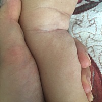 宝宝腿部肤色不均，咋回事