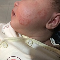 都长了快一个月了还没好，医生说孩子太小了又叫不要管，担心啊