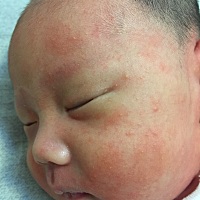 那会起来喂奶，突然发现宝宝全身一片一片的红，耳朵红肿，不知道怎么回事，过了一会又消下去了，有遇到...