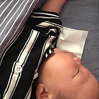 宝宝出生没有，十天左右发现脸上有块褐色，让你越来越明显，这个是啥。能去掉吗