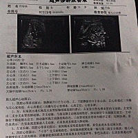 胎儿心电彩超结果、帮忙看一下正常吗？