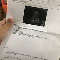 34周宝宝偏大很多 有没有同样情况的宝妈？看看这个B超要紧吗？