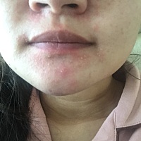 生完了，脸变成了这样，简直惨不忍睹，有谁知道这是怎么了么