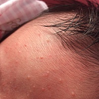 宝宝19天了 这两天额头上长痘是什么情况