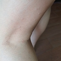 有没有孕妈和我一样，怀孕后，身上容易痒，痒了之后用手抓，越抓越痒，然后起疹子了，之前还少，这两天...