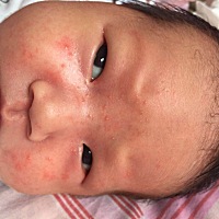 宝贝还没出月子就一脸湿疹，好心疼，有什么方法可以解决吗，求帮助