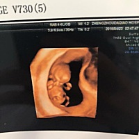 有个问题问孕妈们 做NT的屏幕上是这个颜色的可以看宝宝看的的很清楚  四维跟这个不一样是黑白的像b超一...