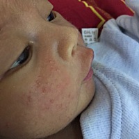 小孩子脸上长这种痘痘是怎么回事？