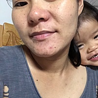 32周+2长了好多痘痘，以前从来不长这些，现在一怀孕就长，皮肤好差黑黑的，受罪啊有没有像我这样的长一...