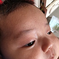 宝宝额头上起的到底是什么啊？医生开的药膏也没用，每天持续增多，急死我了，预防针也没发打！
