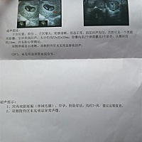 今天去检查发现是同卵双胞胎。有点惊喜，有点意外！没想到我家竟然有双胞胎的基因呀，哈哈😄