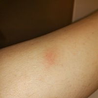 怀孕2个多月，左右腿位置相同长大包，不痒，用力按酸疼！怎么一会事，要不要紧，谁和我一样呀？