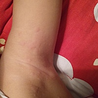 荨麻疹  因为食物，物理，日光或者接触过敏源，引起的一种变态反应，把有害物质隔离！  前几天宝宝荨麻...