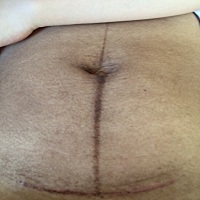 剖腹产后两个月的肚子，孕期一条妊娠纹没长，肚子就中间那条线黑，也不知道生了之后怎么变这样了😂和...