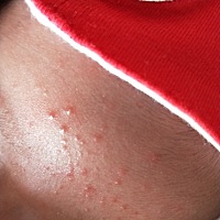 宝宝20天了，额头上长的这个是湿疹还是痱子啊，用什么办法或者药品好的快些，谢谢🙏