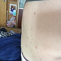 有没有宝妈知道 这是什么？生宝宝前一个星期长 生完之后胸前慢慢的越长越多。有人说是湿疹那么请问怎么...