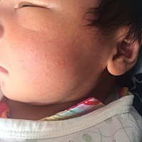 宝宝出生从第七天开始脸上起痘痘，这种是什么？湿疹还是痱子