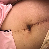 B超几次一直说BB偏小，可生出时却八斤三两，所以不准，这是第三胎剖腹了，感谢医生当时不停帮按肚子排东...