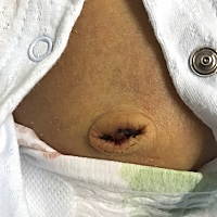 有没有宝妈孩子脐带掉了后，每天都有一点流血啊。是怎么回事。