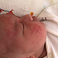 宝宝脸上有湿疹怎么办啊？