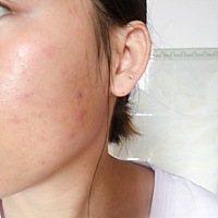 以前的我满脸痘痘，敏感肌肤，不忍直视😏