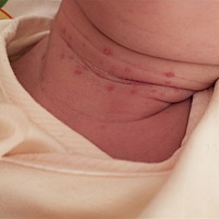 宝妈们。求指教。宝宝脖子上这是什么？