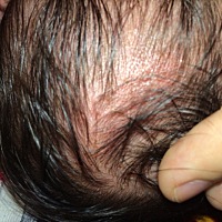 请问有经验的宝宝妈妈们 宝宝25天 头皮发红长了一层白头 医生说脸上头上是湿疹现在不用管没给擦药 这几...