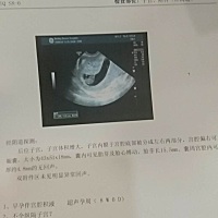 大家看一下我这个八周的孕囊是不是比一般的大啊？是不是表示孩子体格大啊？