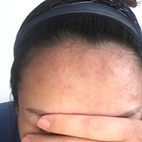 坐月子期间，额头长痘啥情况